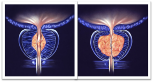  PAE For An Enlarged Prostate