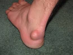 Ganglion Cyst