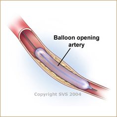 Angioplasty & Stenting - PAD Treatment