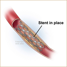 Carotid Artery Stenting - Treatment for Carotid Artery Disease