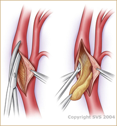 Carotid Endarterectomy - Vascular Disease Treatment