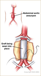 Surgical Aneurysm Repair - Vascular Surgery