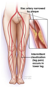 Peripheral Artery Disease (PAD) - Symptoms, Causes, & Treatment
