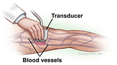 Peripheral Artery Disease (PAD) - Symptoms, Causes, & Treatment