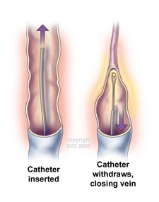 Varicose Veins - Symptoms, Causes, & Treatment