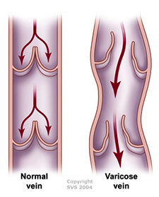 Varicose Veins - Symptoms, Causes, & Treatment