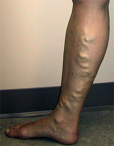 Varicose Veins - Symptoms, Causes, & Treatment