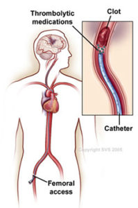 Venous Thrombectomy - Vascular Disease Treatment