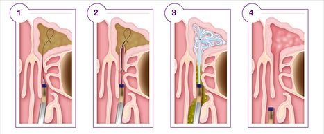 ​In-Office Balloon Sinuplasty