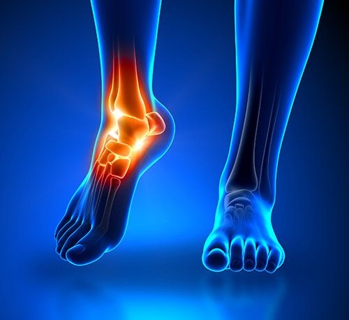 Total Ankle Replacement Surgery (TAR)
