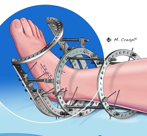 Charcot reconstruction