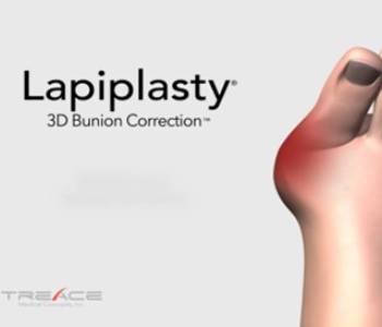 Bunions/Lapiplasty 3D Correction