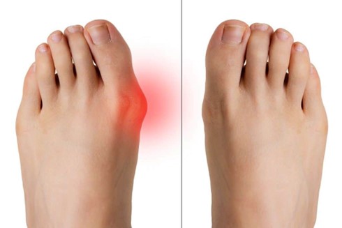MIS Bunion Minimally-Invasive Surgery