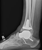 post_surgery_tar1