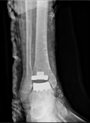 post_surgery_tar2
