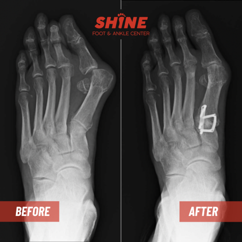 LT_Lap_hammer_2nd_met_osteotomy