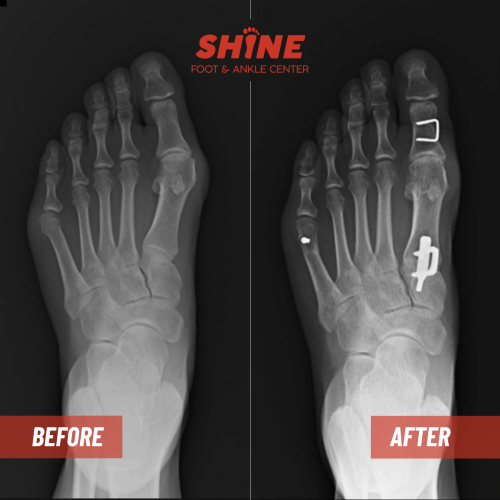 LT_akin_lap_5th_osteo