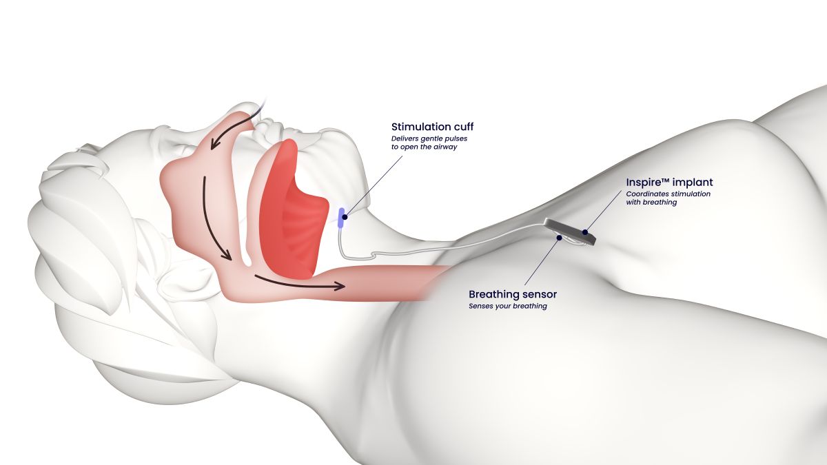 The Procedure
