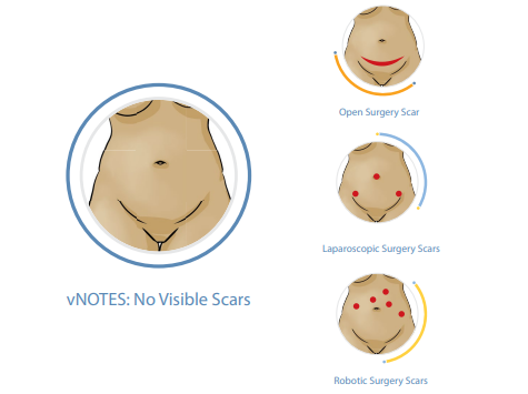 An informational graphic about the surgery