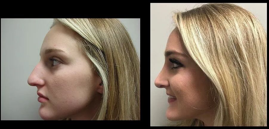 Rhinoplasty