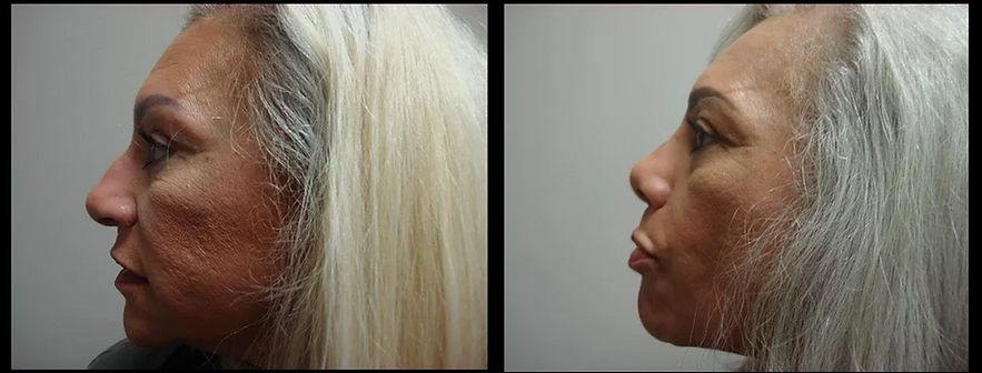 Rhinoplasty