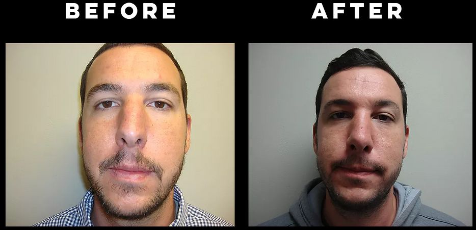 Rhinoplasty