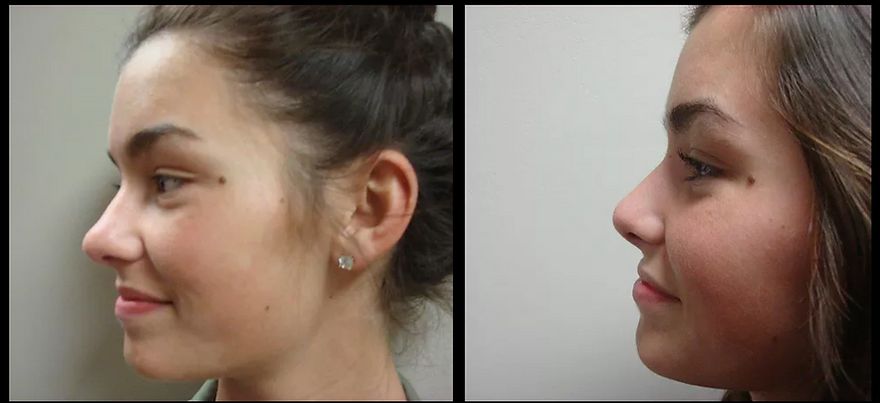 Rhinoplasty