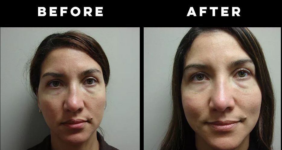 Rhinoplasty