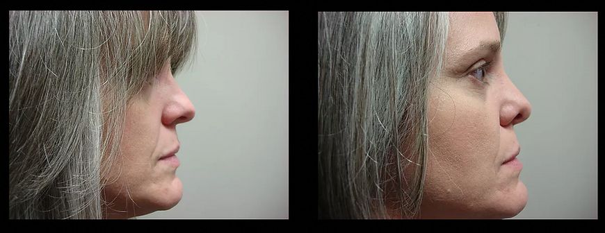 Rhinoplasty
