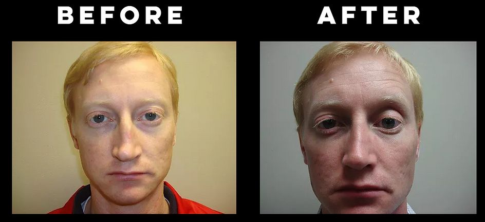 Rhinoplasty