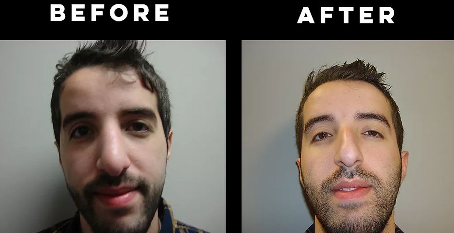 Rhinoplasty