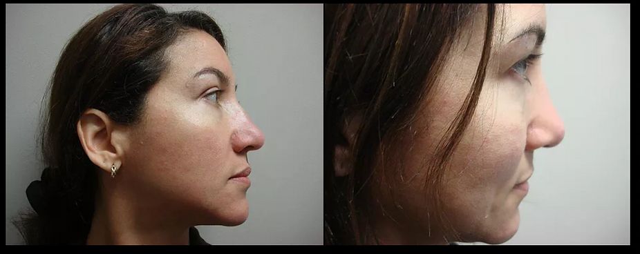 Rhinoplasty