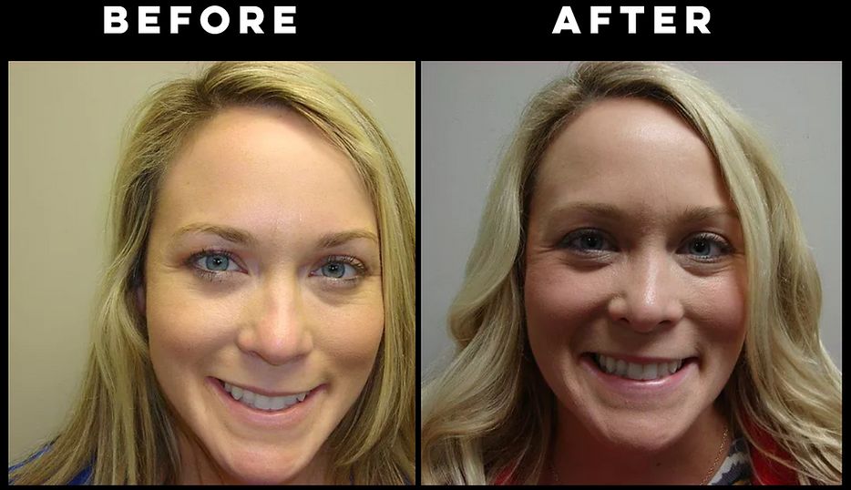 Rhinoplasty