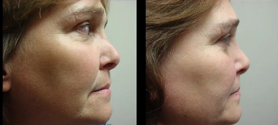 Rhinoplasty