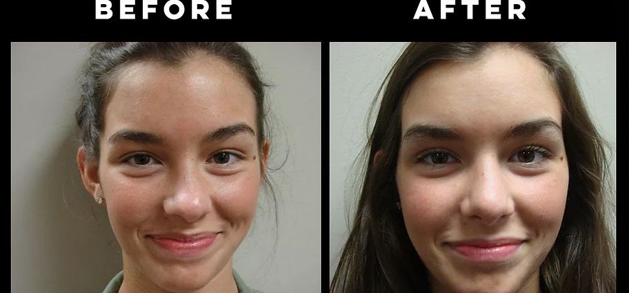 Rhinoplasty