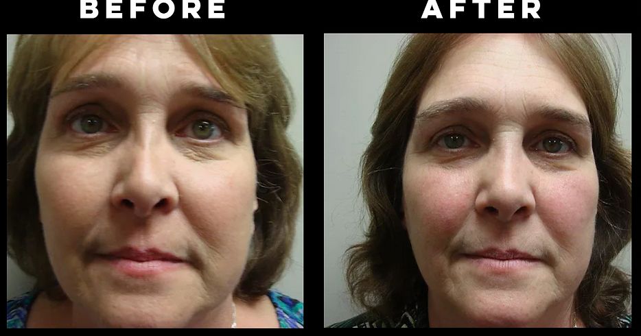 Rhinoplasty
