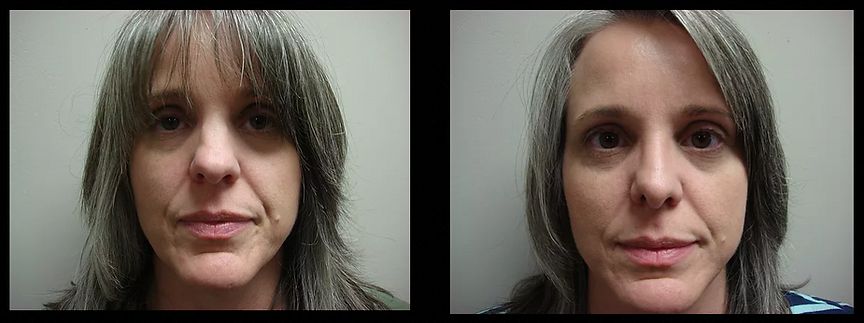 Rhinoplasty