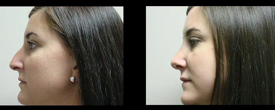Rhinoplasty