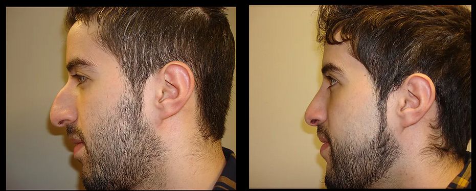 Rhinoplasty