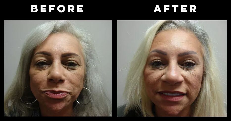 Rhinoplasty