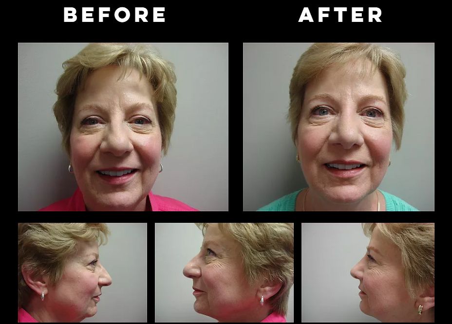 Rhinoplasty