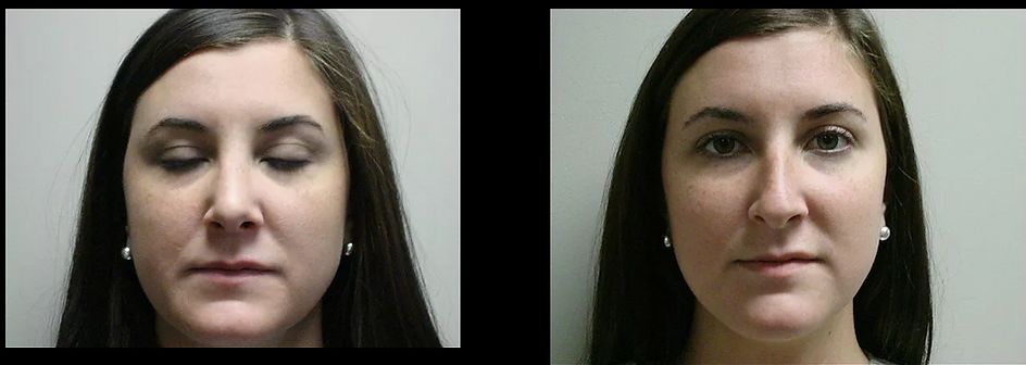 Rhinoplasty