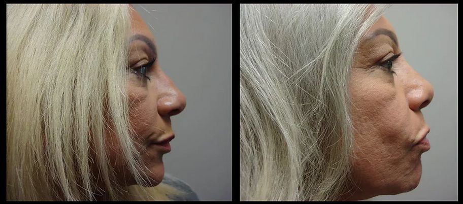 Rhinoplasty