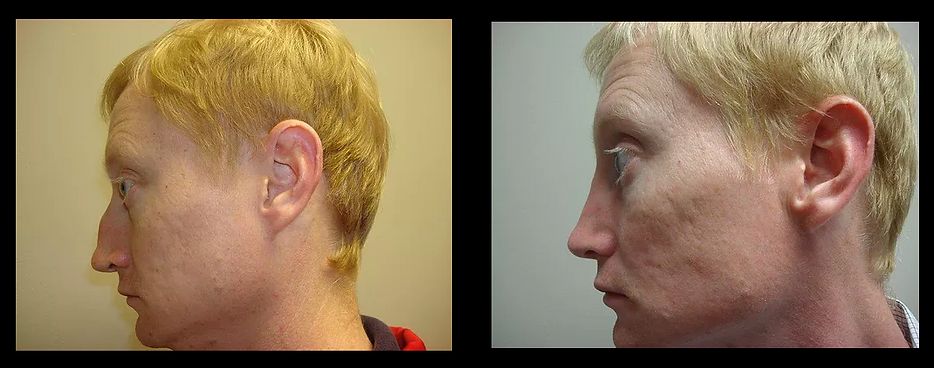 Rhinoplasty
