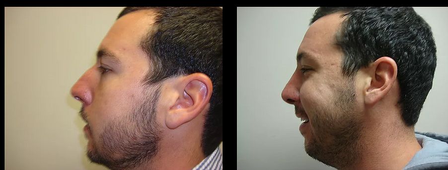 Rhinoplasty