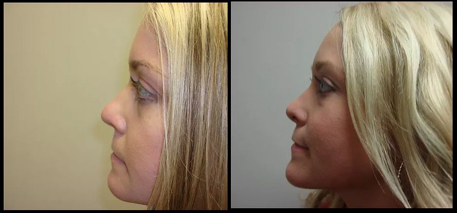 Rhinoplasty