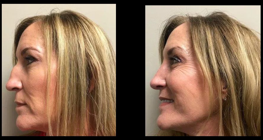 Rhinoplasty
