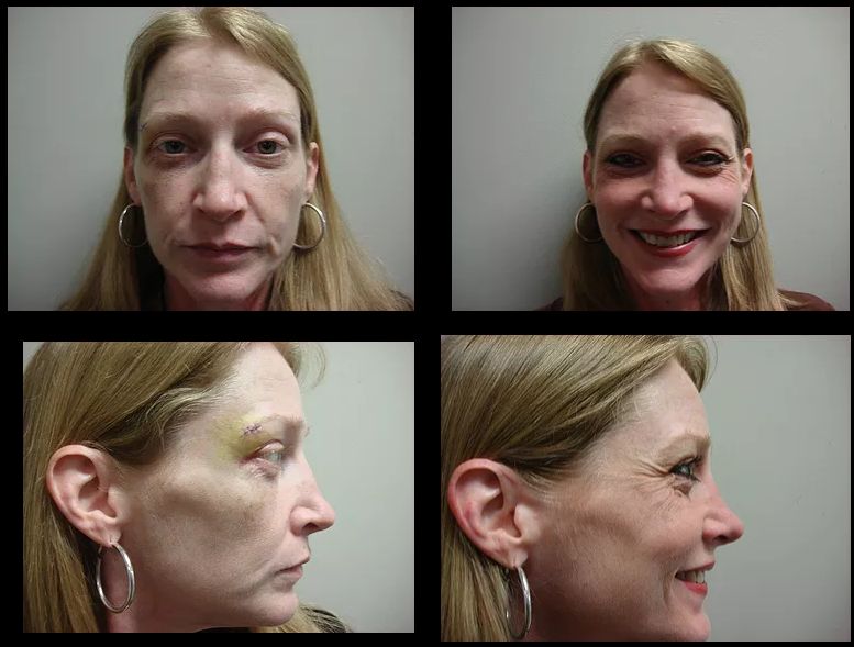 Rhinoplasty