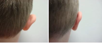 Otoplasty