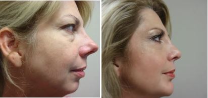 Rhino & Chin Implant